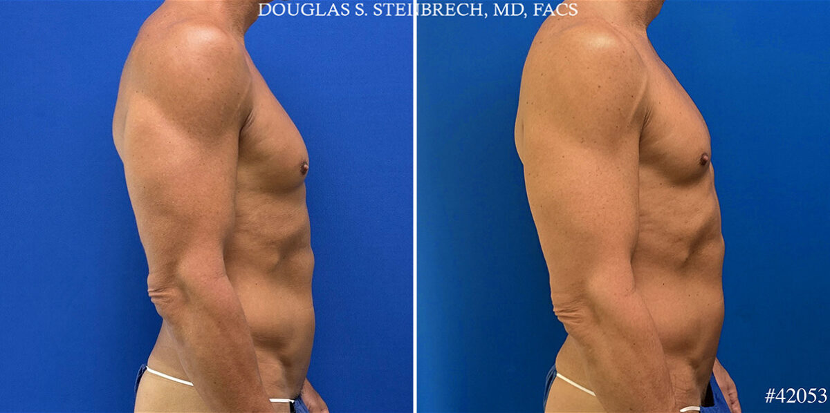 Gynecomastia Before and After Photos in CA, Beverly Hills, Patient 25761