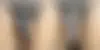 Male Enhancement Before and After Photos in CA, Beverly Hills, Patient 26166