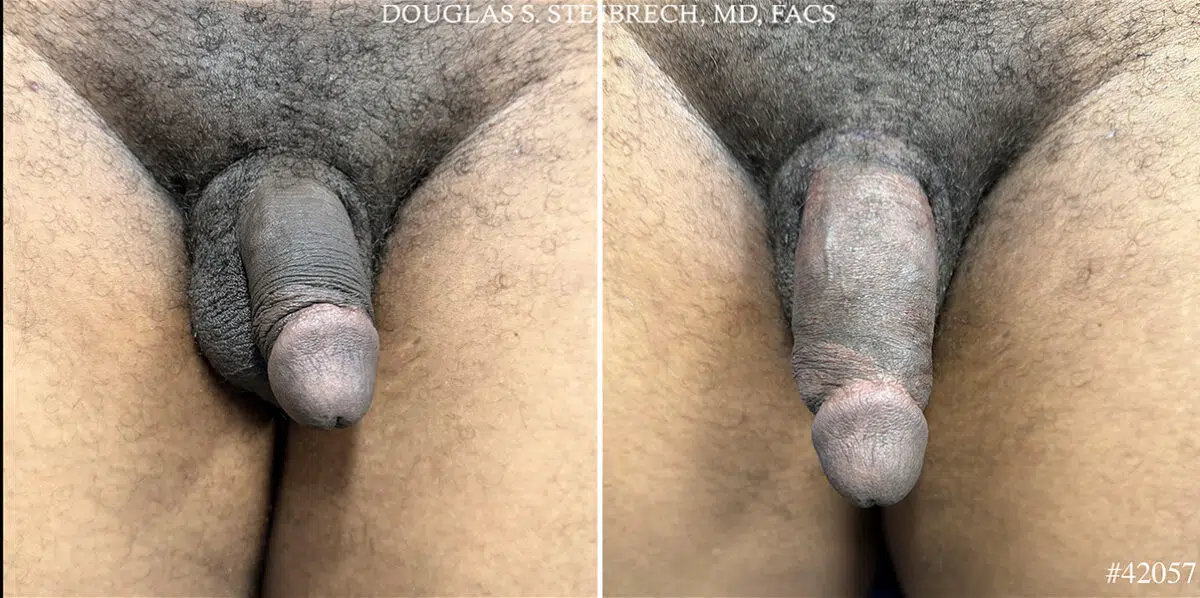 Male Enhancement Before and After Photos in CA, Beverly Hills, Patient 26166