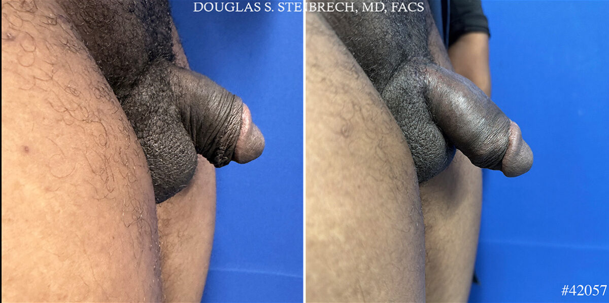 Male Enhancement Before and After Photos in CA, Beverly Hills, Patient 26166