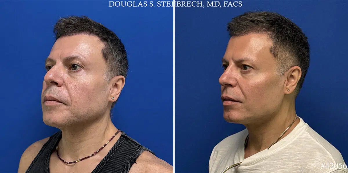 Male Model Make Over Before and After Photos in CA, Beverly Hills, Patient 26185