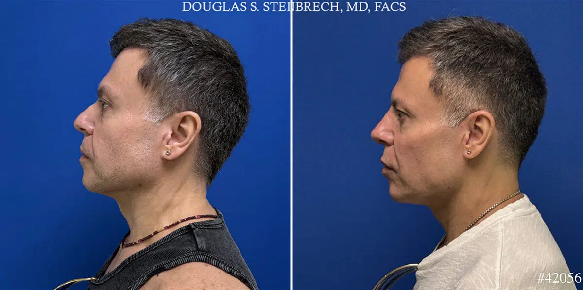 Male Model Make Over Before and After Photos in CA, Beverly Hills, Patient 26185