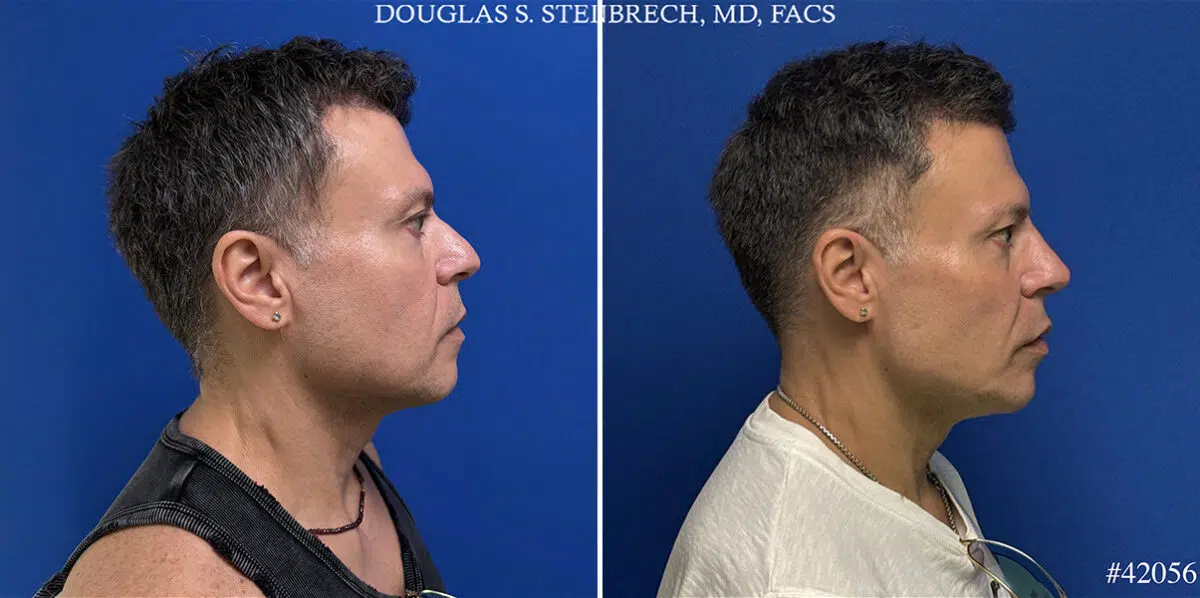 Male Model Make Over Before and After Photos in CA, Beverly Hills, Patient 26185