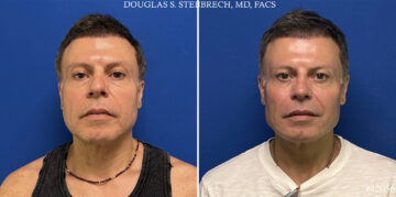 Male Model Make Over Before and After Photos in CA, Beverly Hills, Patient 26185