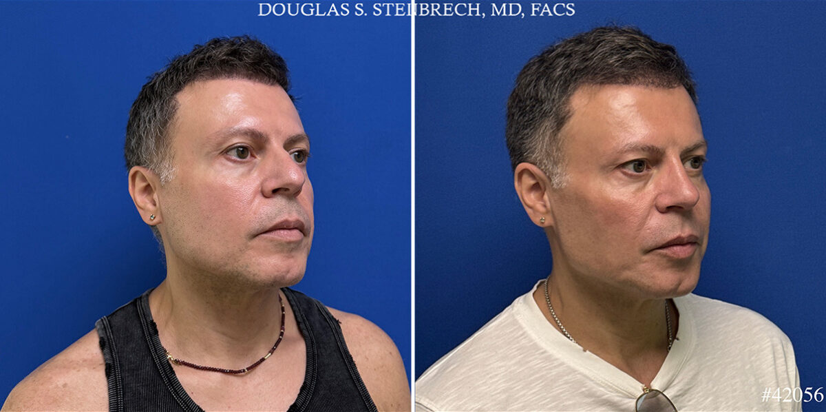 Male Model Make Over Before and After Photos in CA, Beverly Hills, Patient 26185