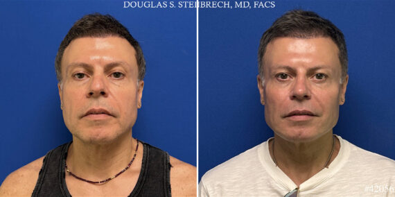 Male Model Make Over Before and After Photos in CA, Beverly Hills, Patient 26185
