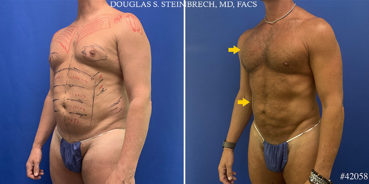 Body Banking Before and After Photos in CA, Beverly Hills, Patient 26213
