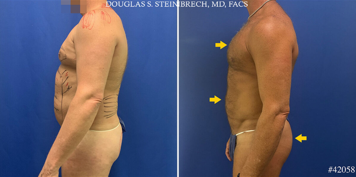 Body Banking Before and After Photos in CA, Beverly Hills, Patient 26213