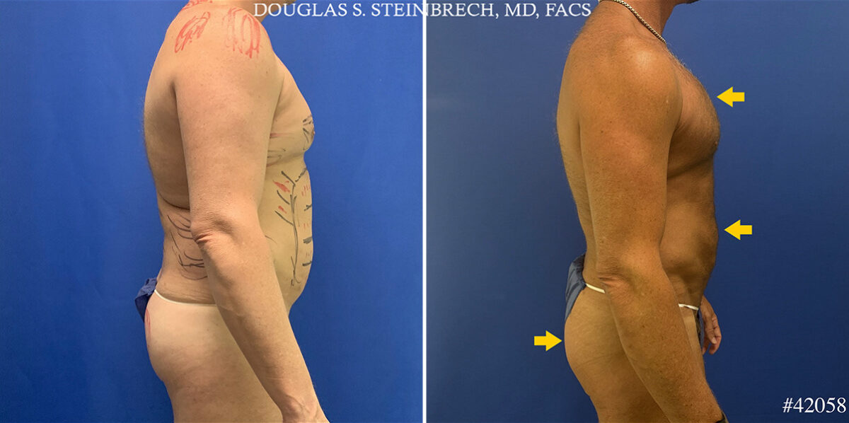 Body Banking Before and After Photos in CA, Beverly Hills, Patient 26213
