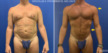 Body Banking Before and After Photos in CA, Beverly Hills, Patient 26213