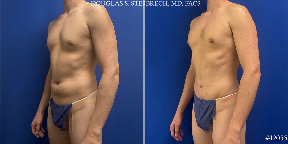 Body Banking Before and After Photos in CA, Beverly Hills, Patient 26226