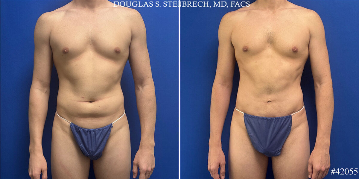 Body Banking Before and After Photos in CA, Beverly Hills, Patient 26226
