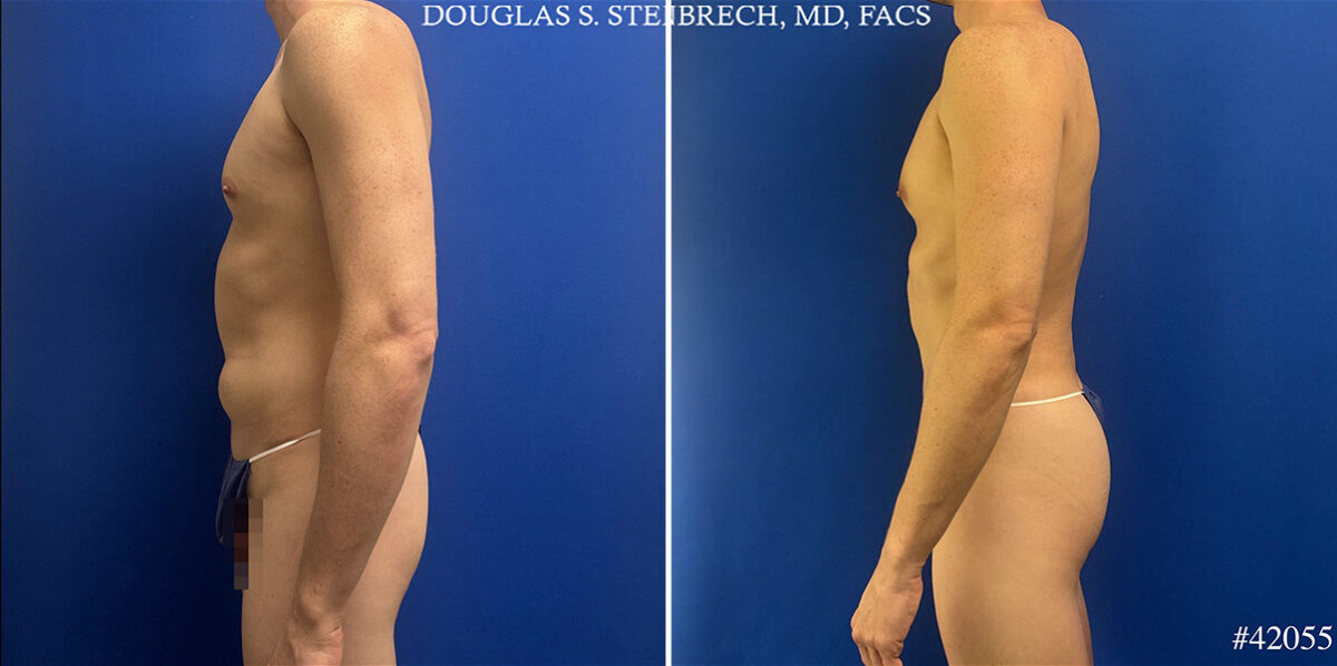 Body Banking Before and After Photos in CA, Beverly Hills, Patient 26226