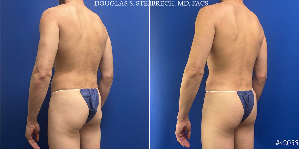 Body Banking Before and After Photos in CA, Beverly Hills, Patient 26226