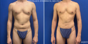 Body Banking Before and After Photos in CA, Beverly Hills, Patient 26226