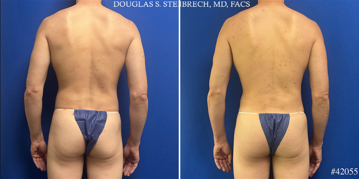Body Banking Before and After Photos in CA, Beverly Hills, Patient 26226