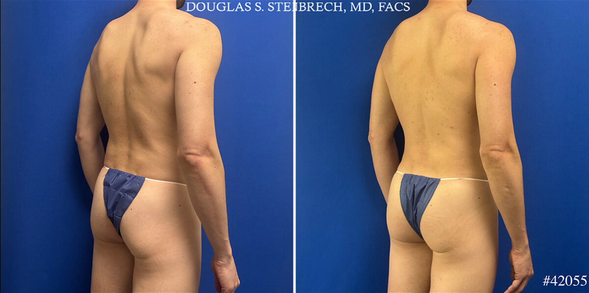 Body Banking Before and After Photos in CA, Beverly Hills, Patient 26226