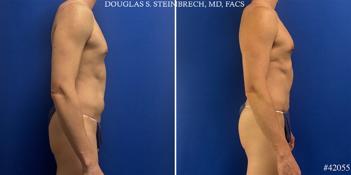 Body Banking Before and After Photos in CA, Beverly Hills, Patient 26226