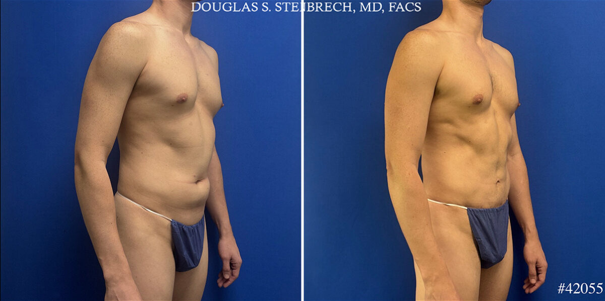 Body Banking Before and After Photos in CA, Beverly Hills, Patient 26226